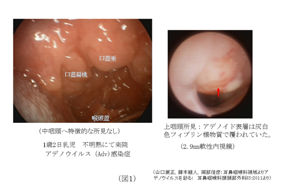 アデノ ウイルス 大人