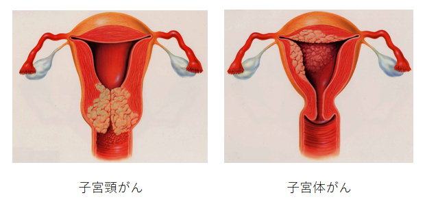 子 宮頸 が ん 異 形成 治っ た