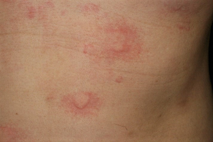 写真 鯖 アレルギー 蕁麻疹 「サバにアレルギー」の危険な誤解…アレルギーと思い込み、ヒスタミン中毒やアニサキス症悪化も